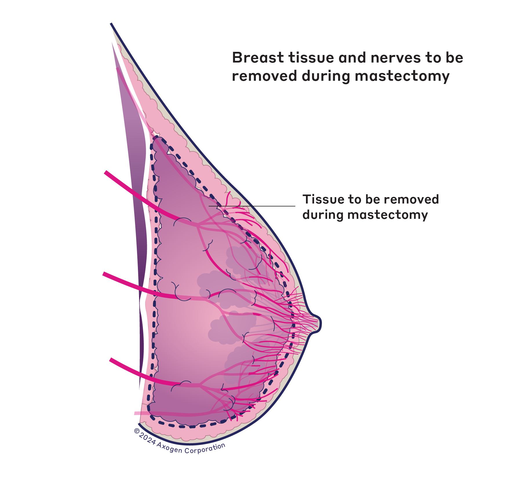 A side-view illustration of a right breast, with a label noting the area of breast tissue that is removed during nipple-sparing mastectomy