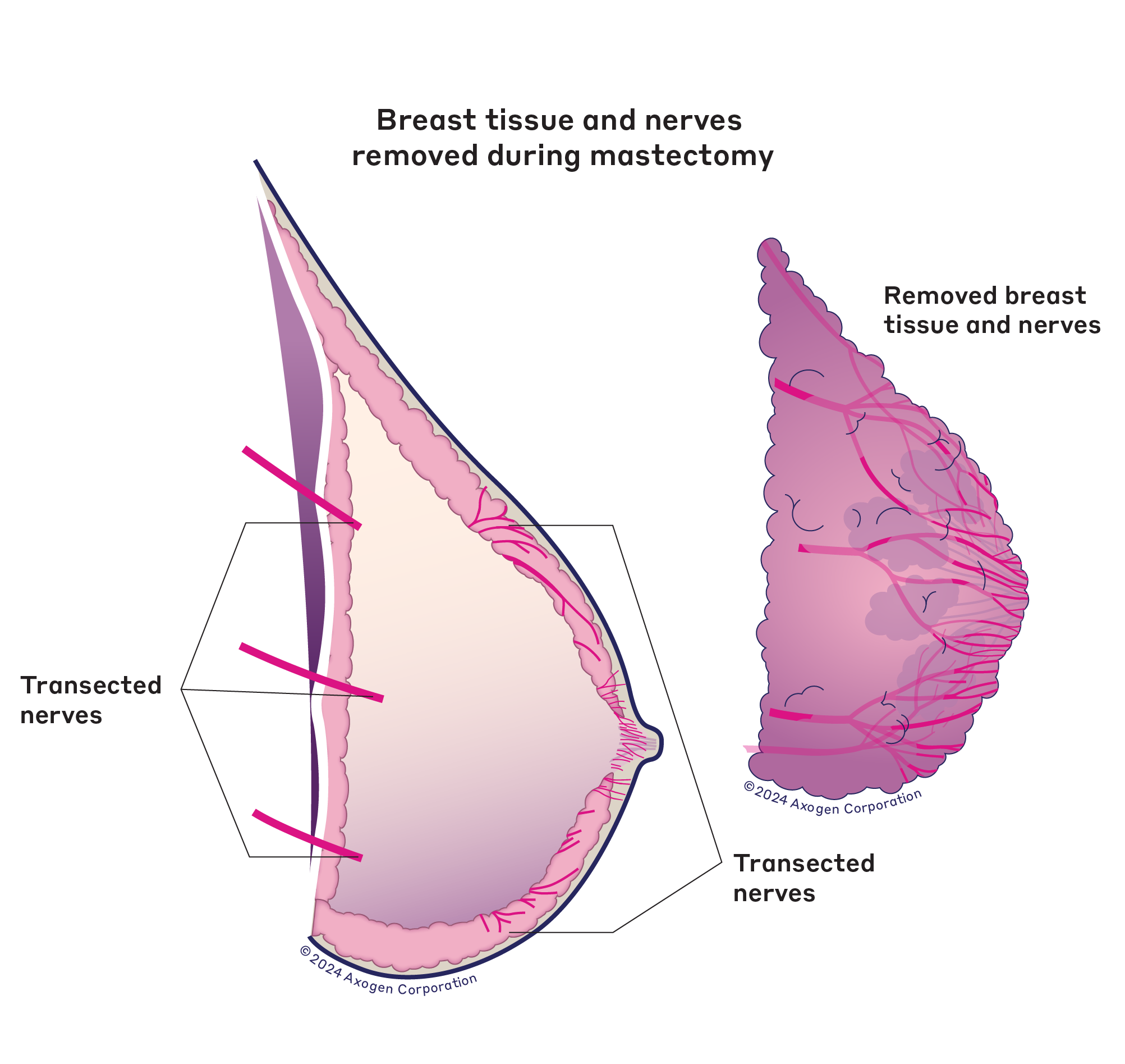 A side-view illustration of a right breast after nipple-sparing mastectomy, showing both the removed breast tissue and transected nerves