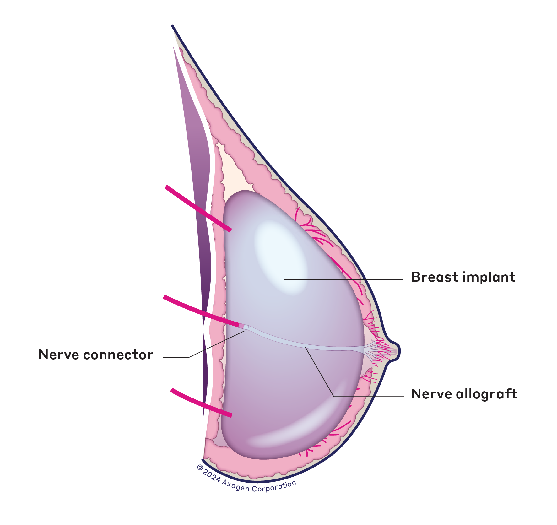 A side view illustration of a right breast after implant reconstruction with Resensation, showing the newly implanted nerve allograft