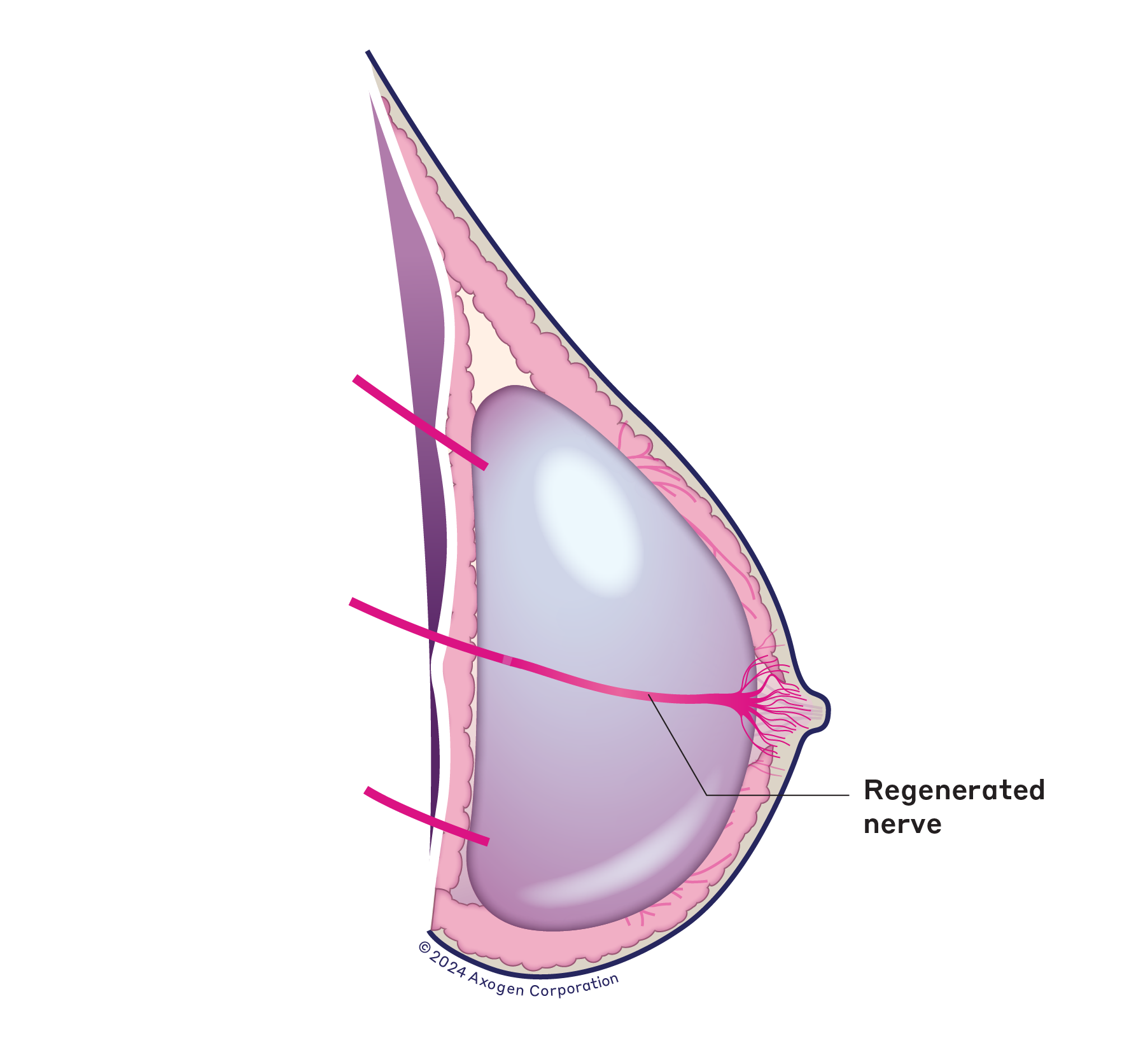 A side-view illustration of a right breast after implant reconstruction with Resensation, showing the length of regenerated nerve